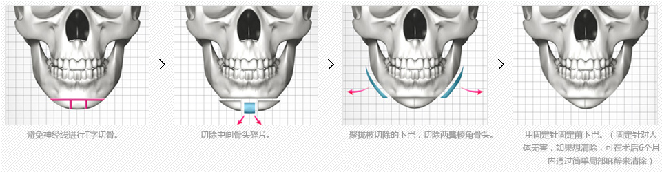 韩国下颌角整形术后的护理